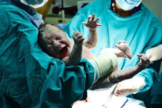 Nascer por cesárea pode ser prejudicial à saúde?