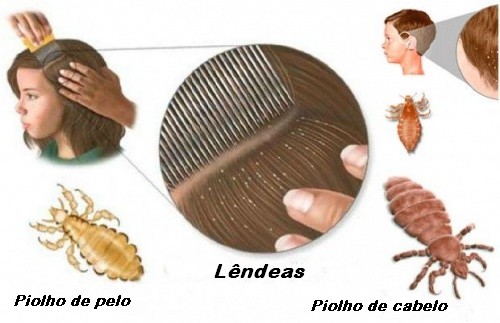 Remédios caseiros para piolhos e lêndeas