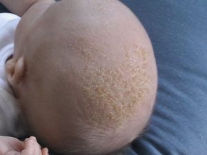 O que são essas escamas na pele dos bebês?