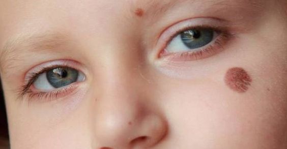 fique atenta as manchas de nascença