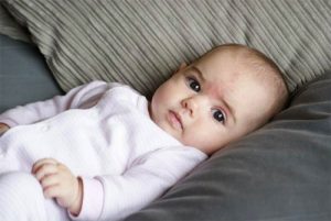 O que causam as manchas de nascença nos bebês?