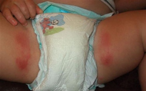 Quais são os sintomas da candidíase no bebê