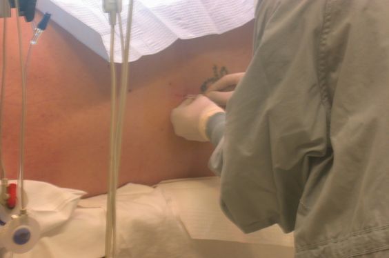 Anestesia epidural
