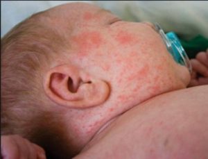 O que são essas manchinhas vermelhas na pele do bebê?