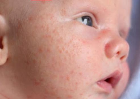 O que é acne neonatal?