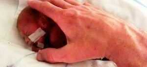 Conheça a história do bebê mais prematuro do mundo