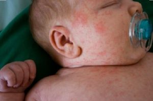 O que você não sabia sobre a escarlatina