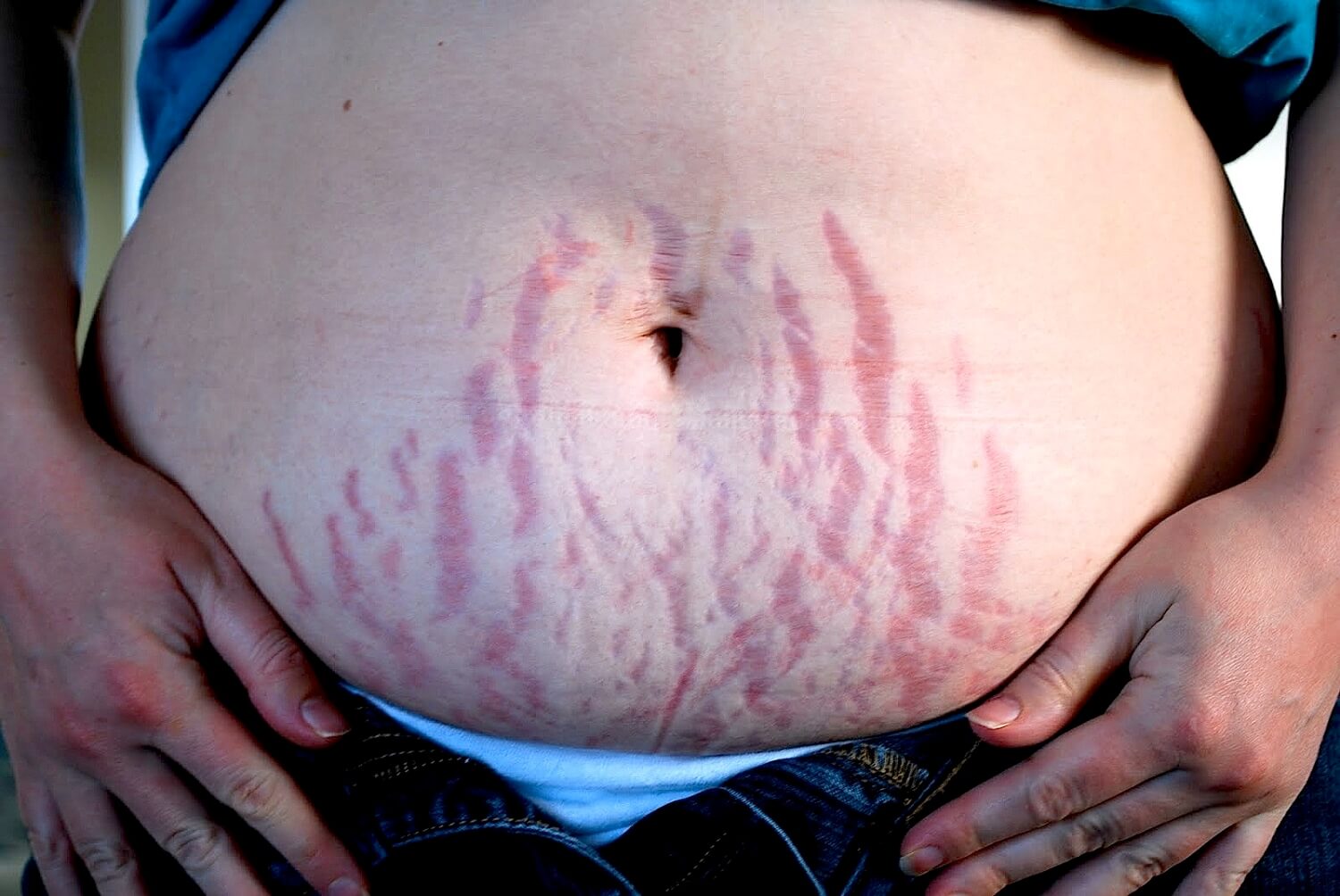 estrias durante a gravidez