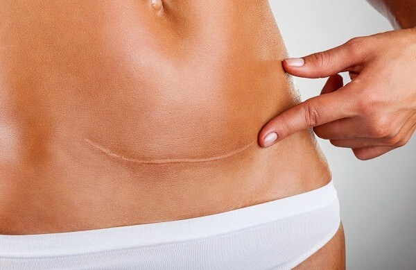 cicatriz da cesária