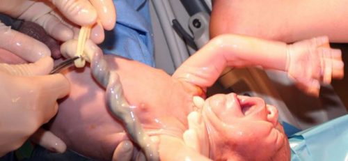 A doação do cordão umbilical pode salvar vidas