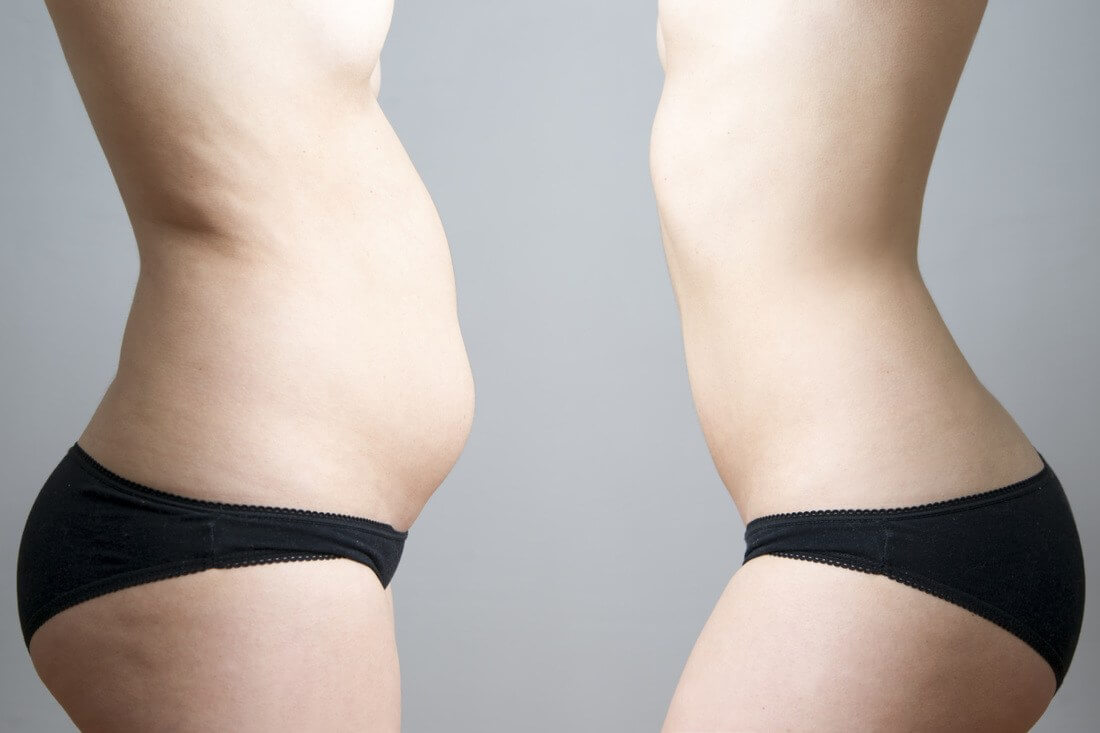 antes e depois de uma barriga com diástase abdominal