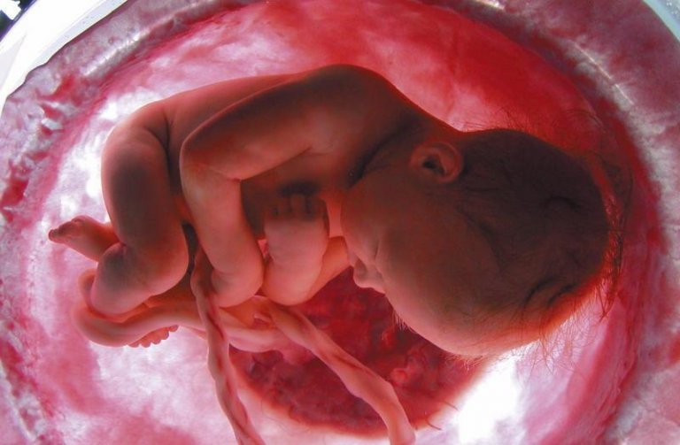 Bebê no ventre materno com prolapso do cordão umbilical