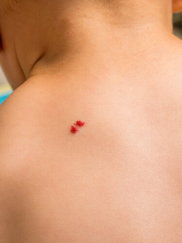 Como tratar angiomas na pele