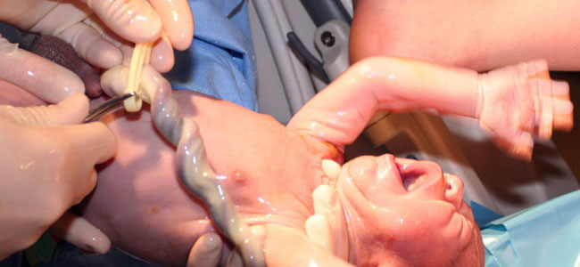 Nascimento de um bebê com prolapso do cordão umbilical