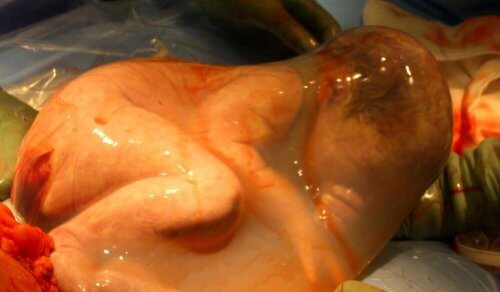 O bebê nasce com a bolsa amniótica intacta: o parto empelicado
