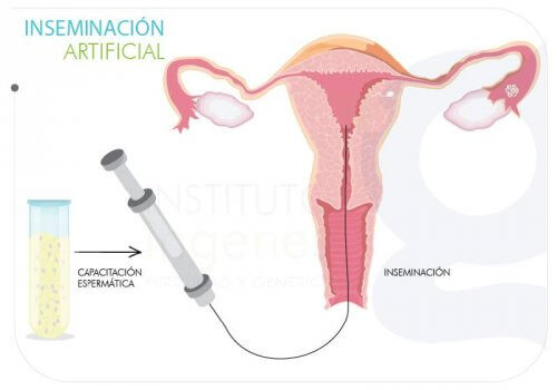 A inseminação artificial: no que consiste e acessibilidade