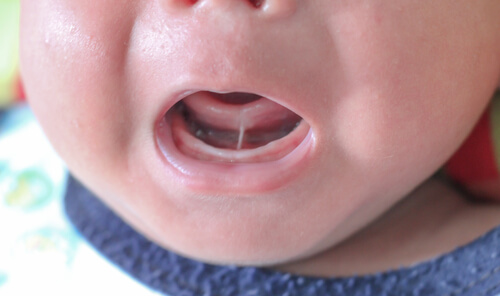 Anquiloglossia ou freio lingual curto nas crianças