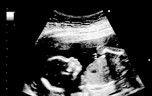 18ª semana de gravidez