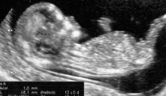 ultrassom do bebê
