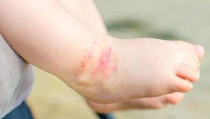 15 conselhos para cuidar da dermatite atópica nas crianças