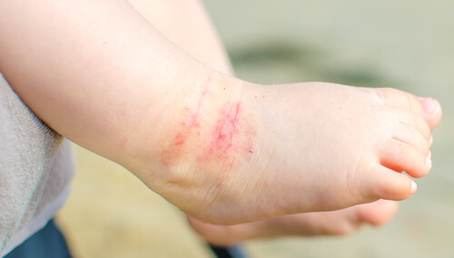 15 conselhos para cuidar da dermatite atópica nas crianças