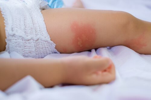 alergias alimentares em crianças