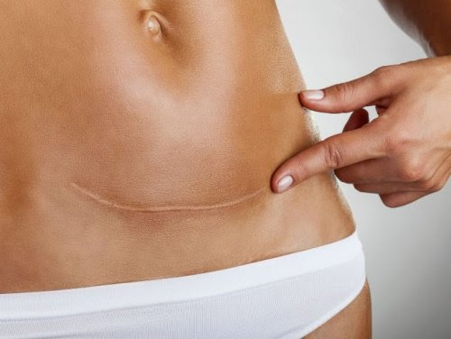 muitas mulheres buscam uma forma de atenuar as cicatrizes