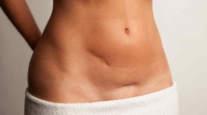 O que fazer para atenuar a marca das cicatrizes