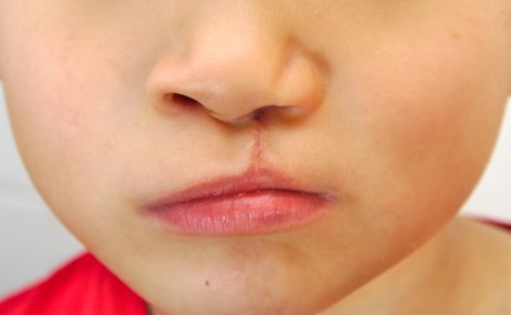 O lábio leporino: o que é e quais são suas consequências
