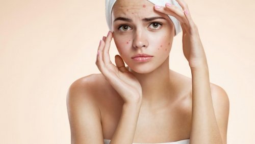 acne na gravidez