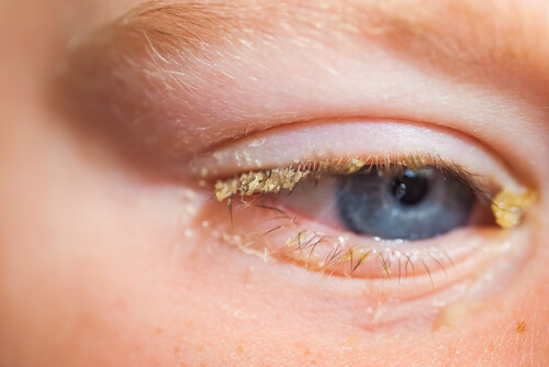 conjuntivite em bebês, como tratar