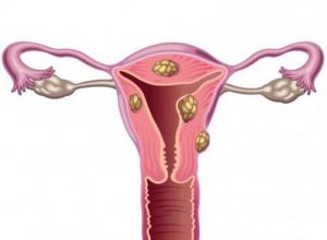 Os miomas uterinos e a infertilidade
