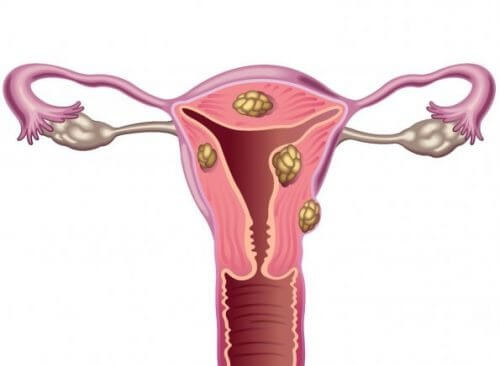 Os miomas uterinos e a infertilidade Os miomas uterinos e a infertilidade