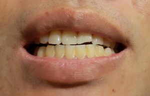 Aparecimento de manchas nos dentes permanentes