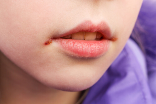 As boqueiras nas crianças: causas e tratamento