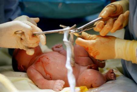 cortar o cordão umbilical após o nascimento