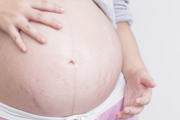 Estrias durante a gravidez: saiba como evitá-las de forma fácil