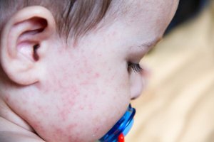 Alergias alimentares comuns em crianças