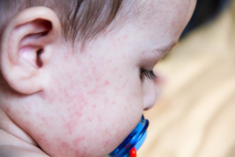 Alergia ao suor em crianças - Sou Mamãe