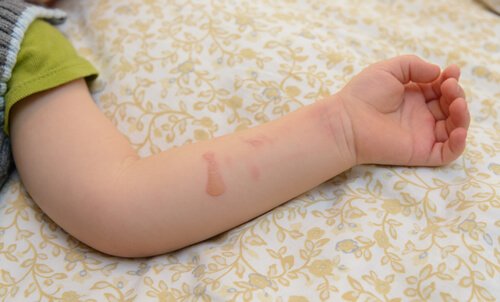 Se seu filho se queimar com água fervente, avalie a ferida para saber que ajuda aplicar.