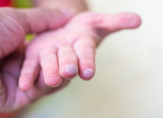 Bolhas nas crianças: como cuidar?