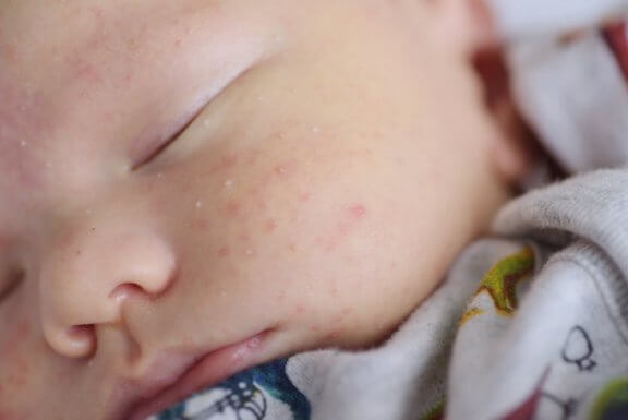 O milium facial do recém-nascido