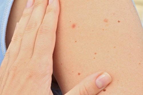 É possível prevenir o aparecimento de manchas