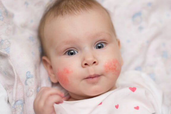 Dermatite atópica em crianças: como prevenir os surtos