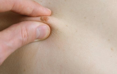 Principais características das manchas nas crianças