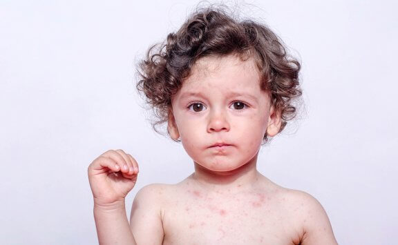 Alergia ao suor em crianças
