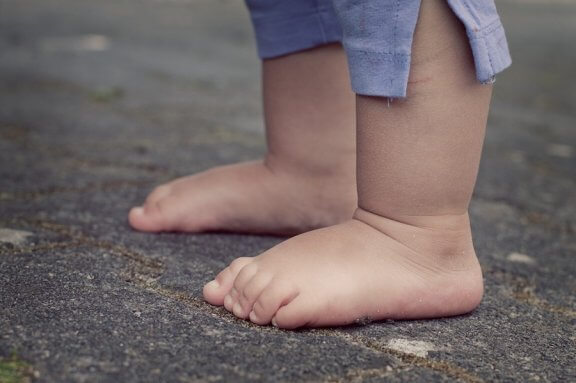 Acondroplasia em crianças