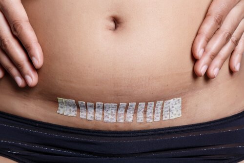 O que é uma histerectomia?