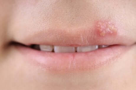 Como curar as bolhas na boca causadas pelo herpes