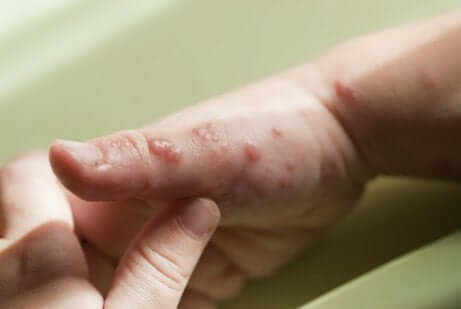 Bolhas causadas pelo herpes na mão de uma criança